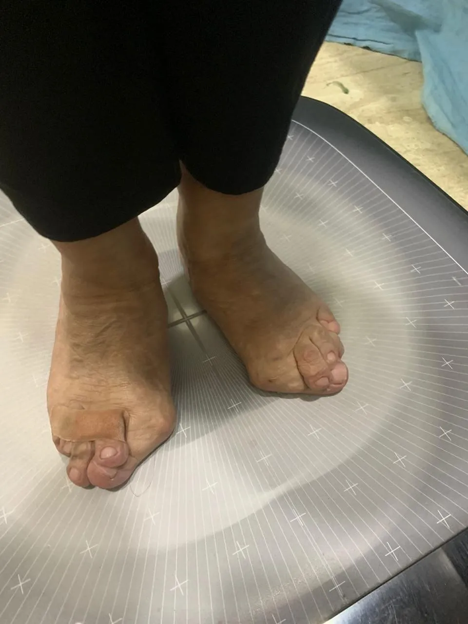 B/L Toe Bunion