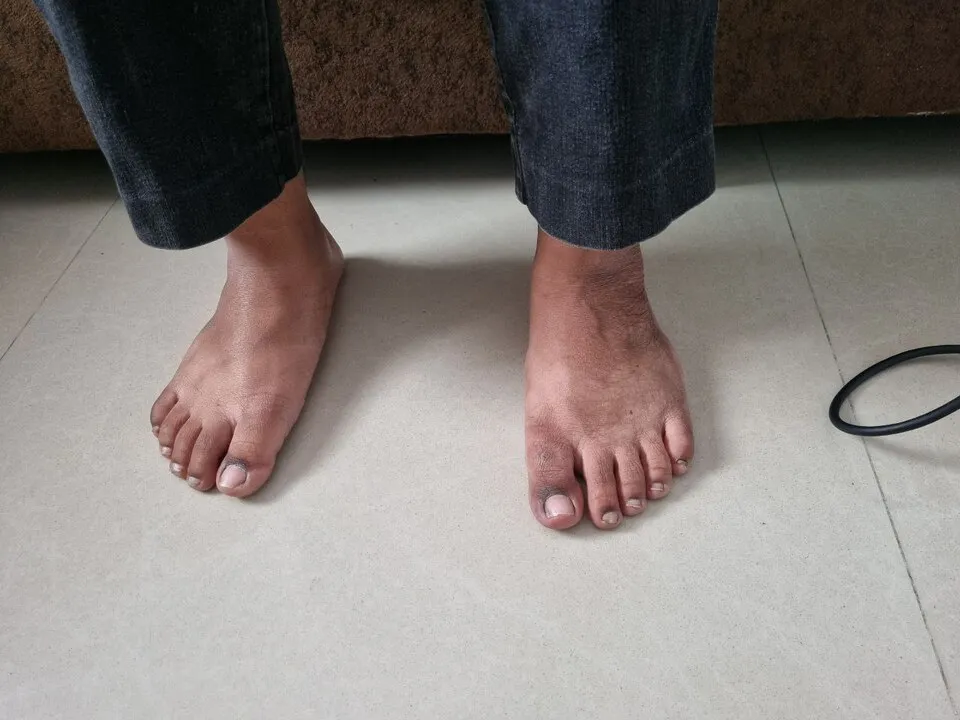 Flat Foot