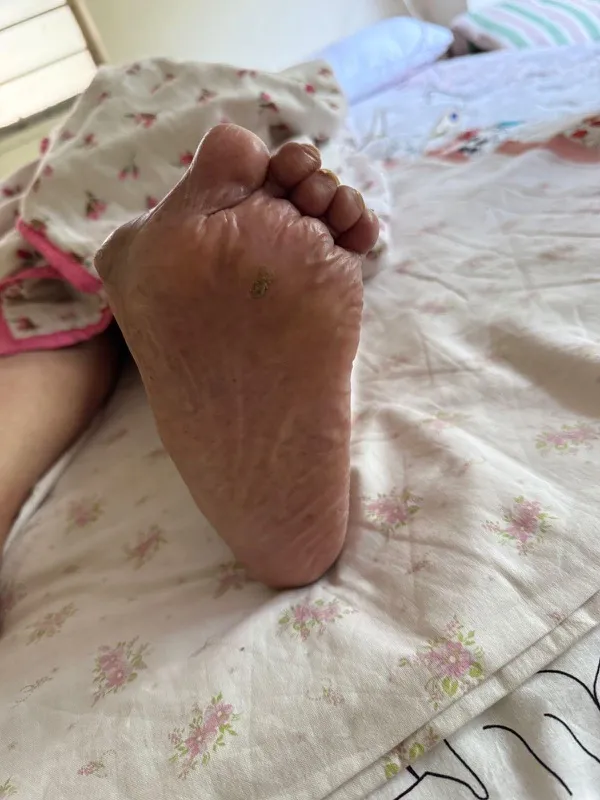 Treated Condition 1