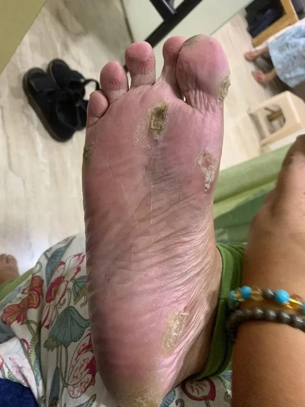 Treated Condition 14