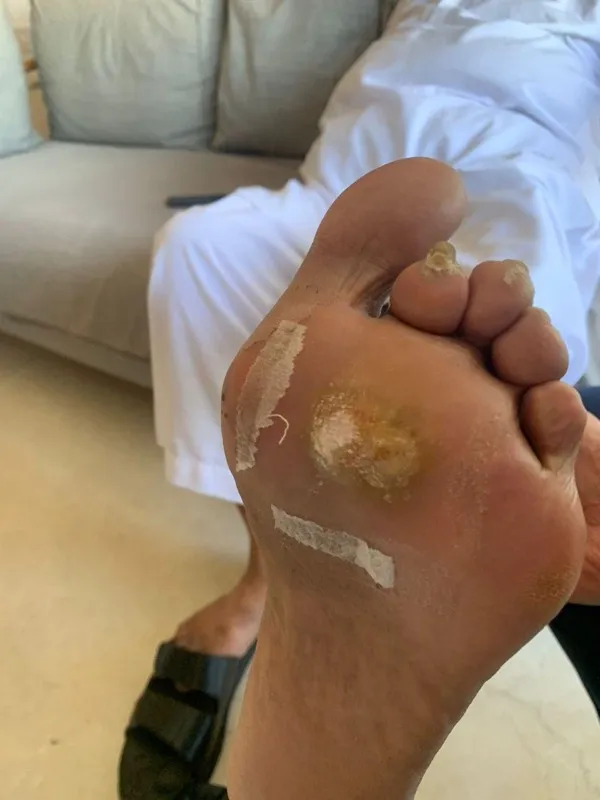Treated Condition 18