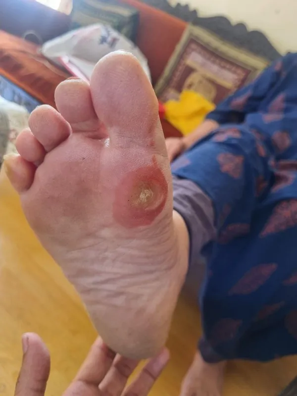 Treated Condition 22
