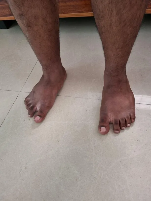 Treated Condition 25