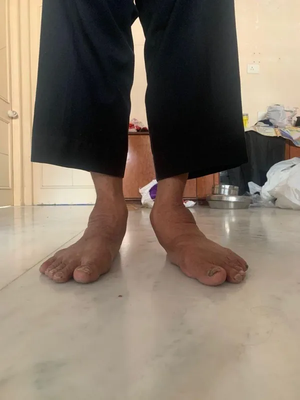 Treated Condition 28