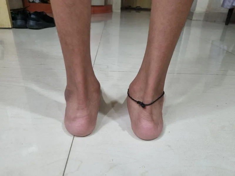 Treated Condition 31