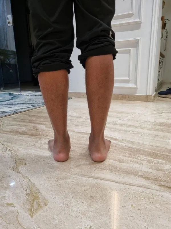 Treated Condition 32