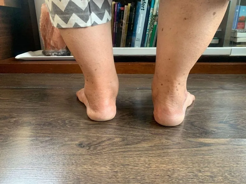 Treated Condition 34