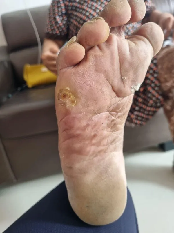 Treated Condition 35
