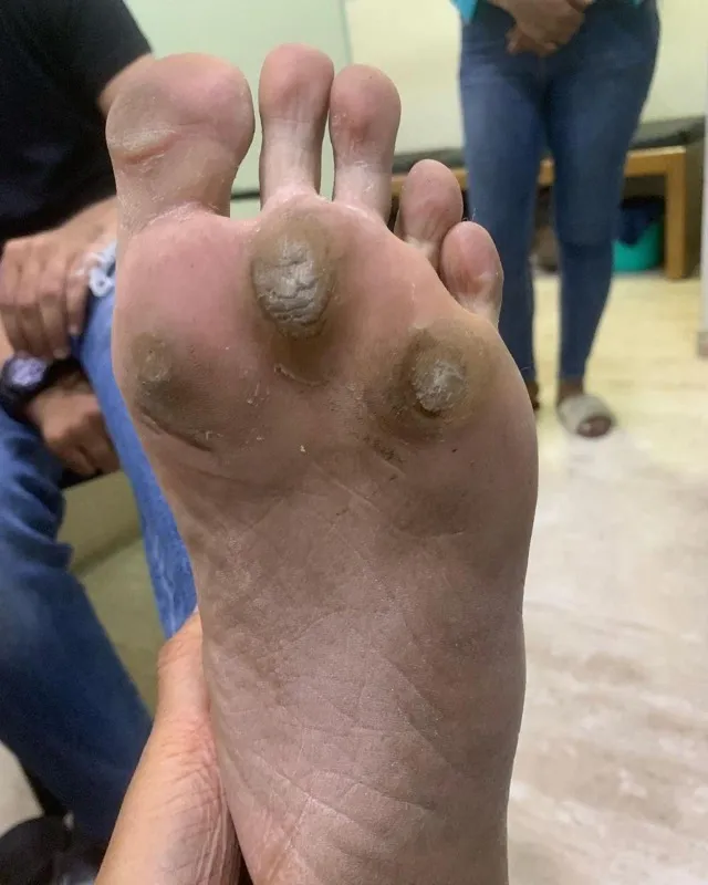 Treated Condition 38