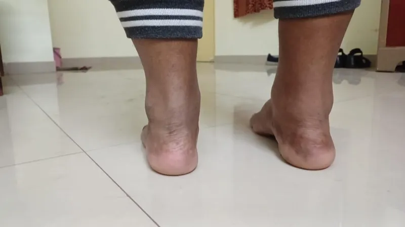 Treated Condition 40