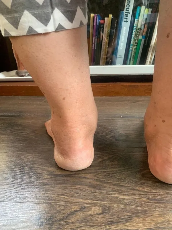 Treated Condition 42