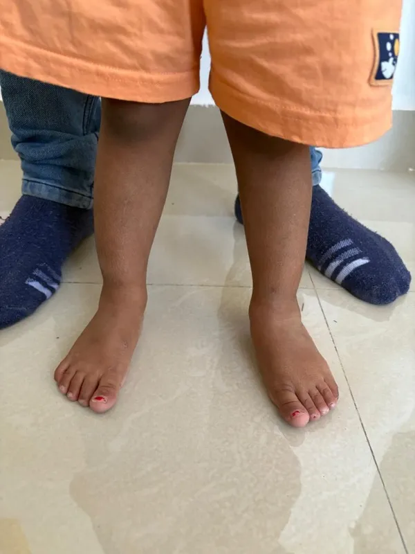 Treated Condition 51