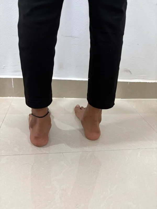 Treated Condition 52