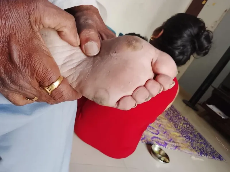 Treated Condition 56