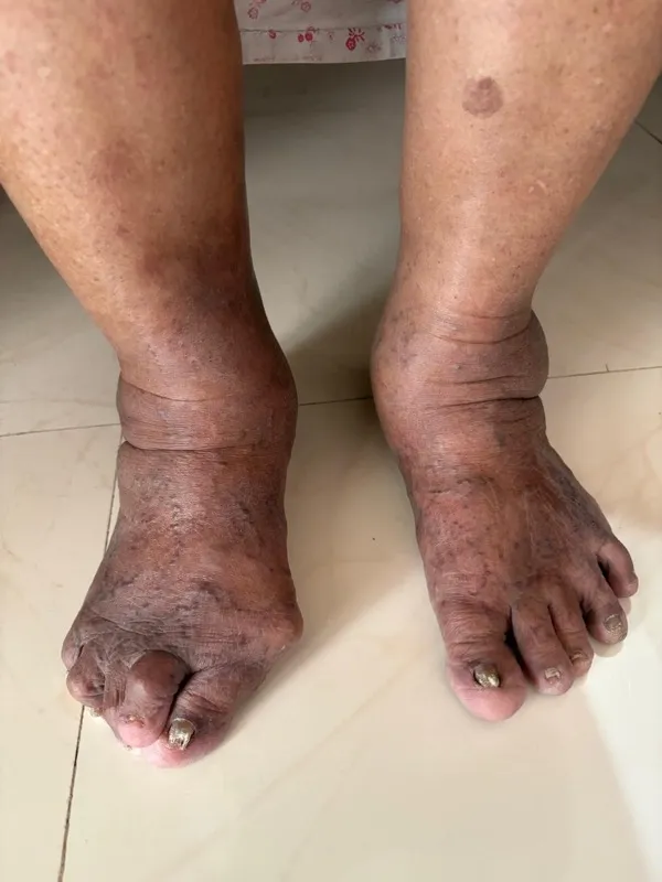 Treated Condition 58