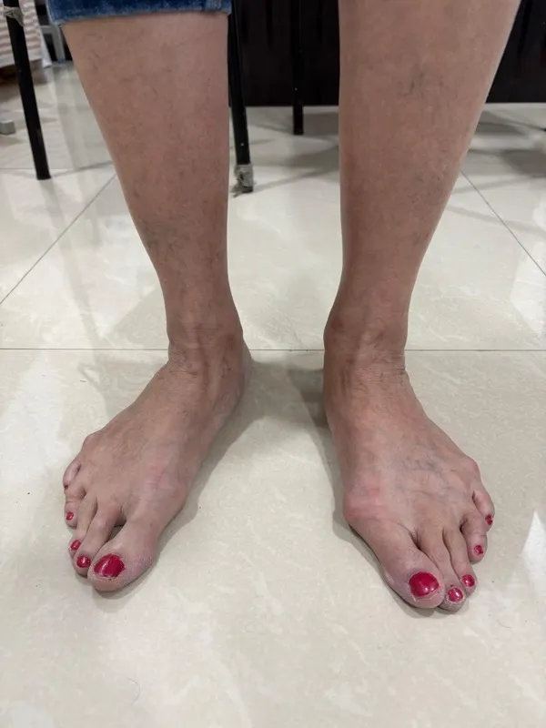 Treated Condition 60