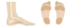 Supinated Foot Structure